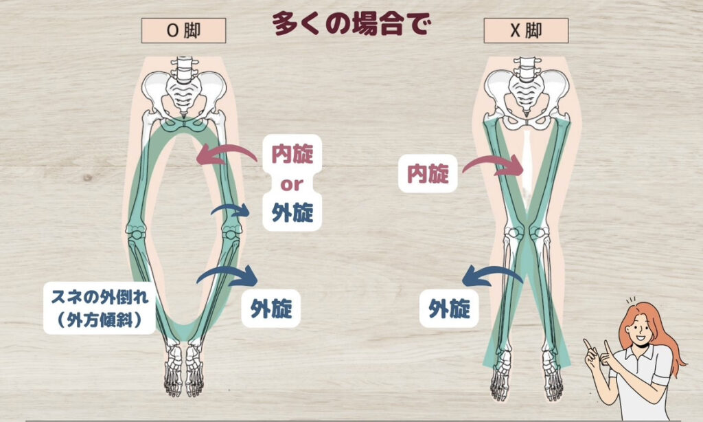 O脚とX脚の原理原則