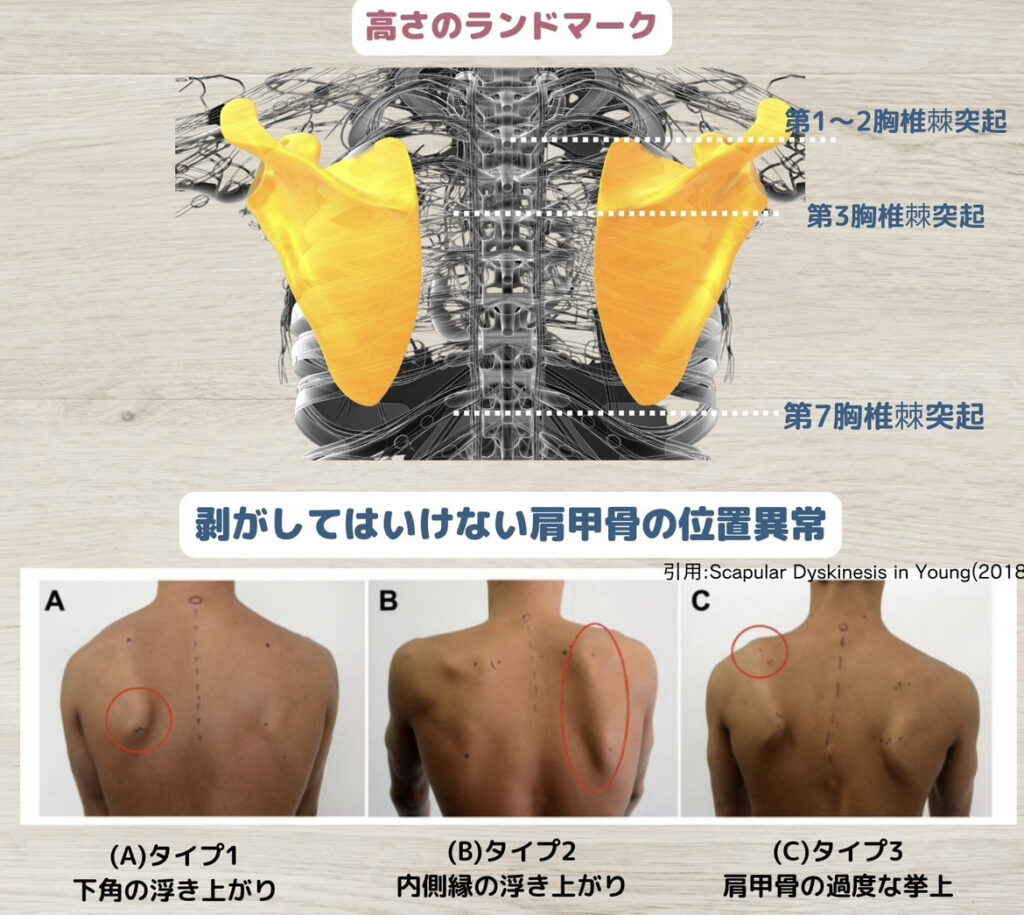 剥がしてはいけない肩甲骨の位置異常
