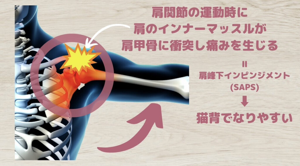 猫背と肩の痛み