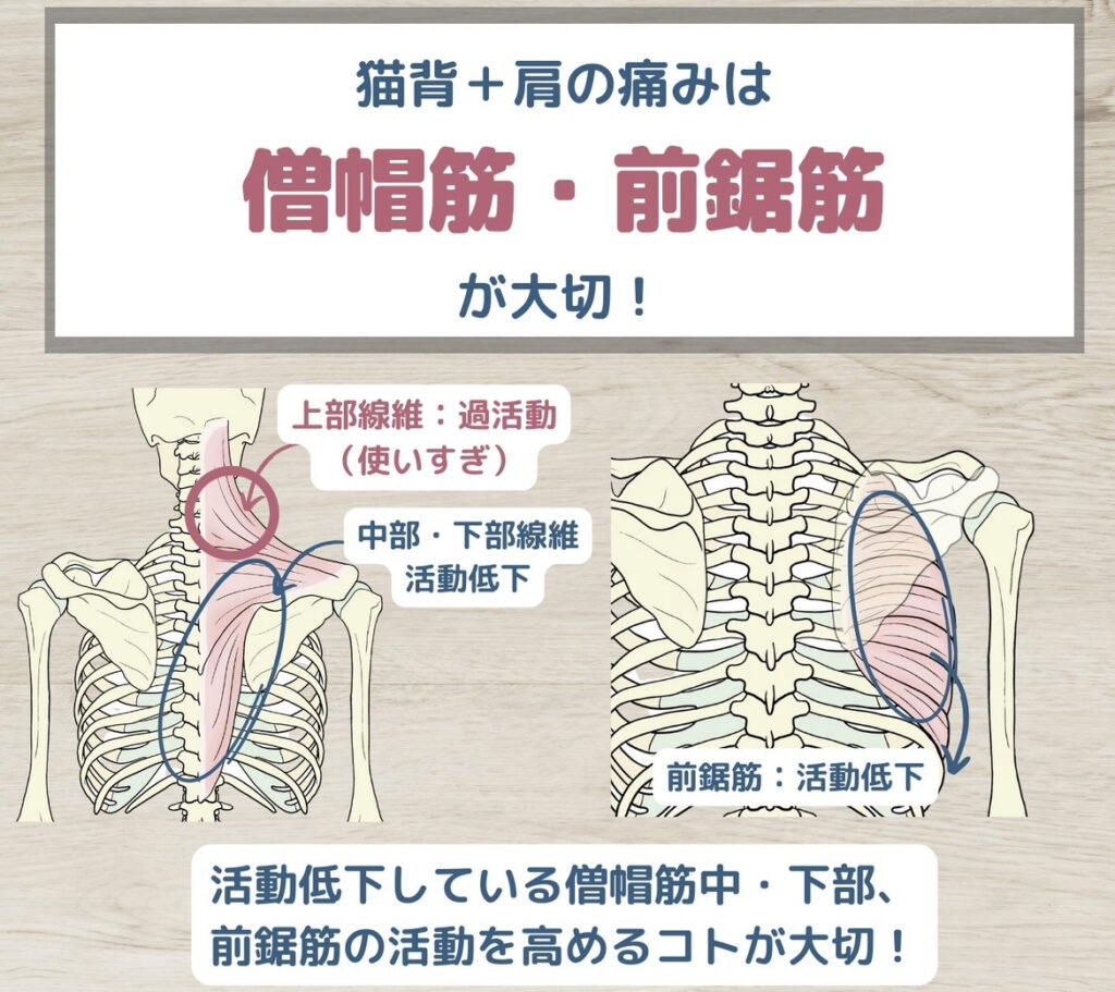 猫背と肩の痛み