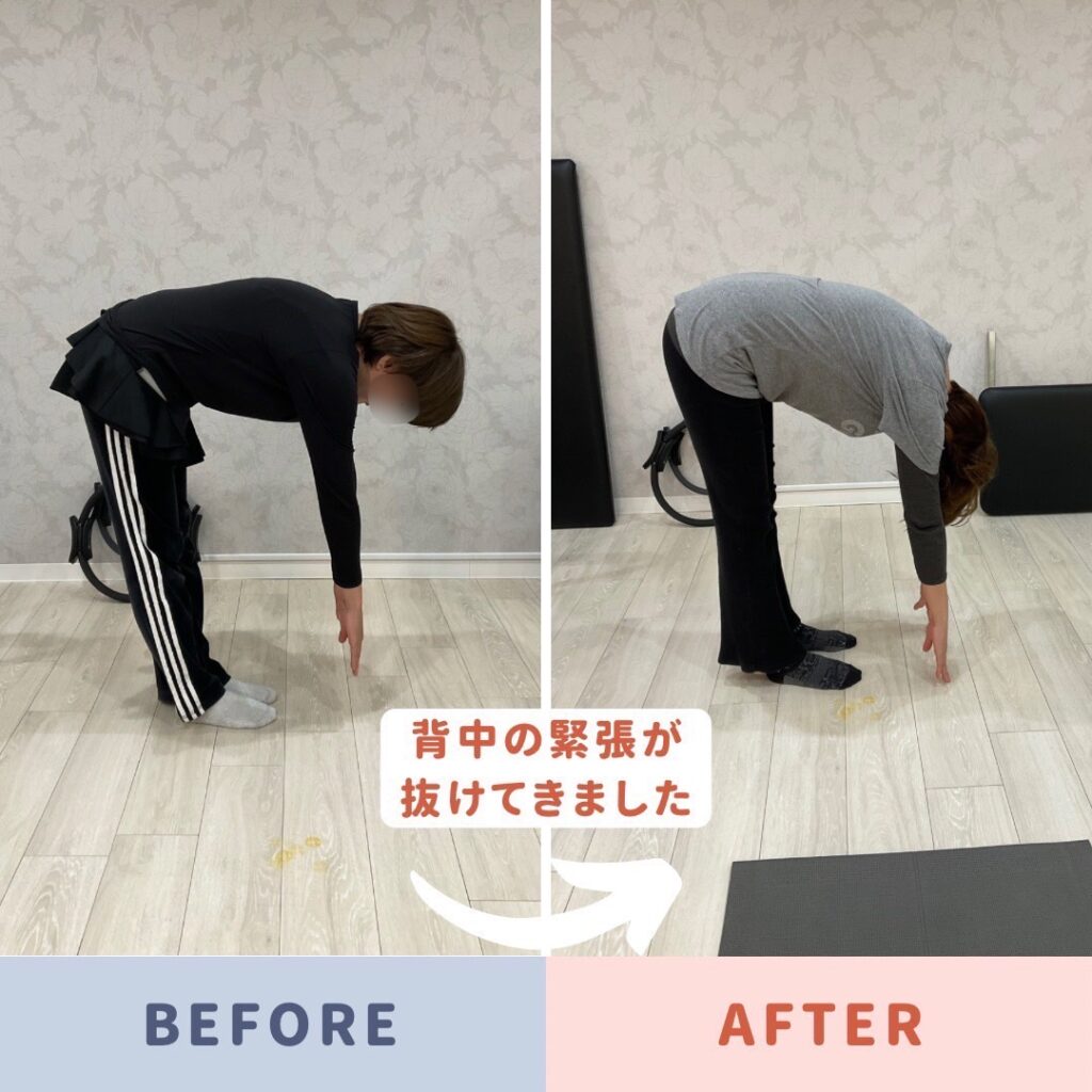 反り腰と腰痛で悩まれていたお客様