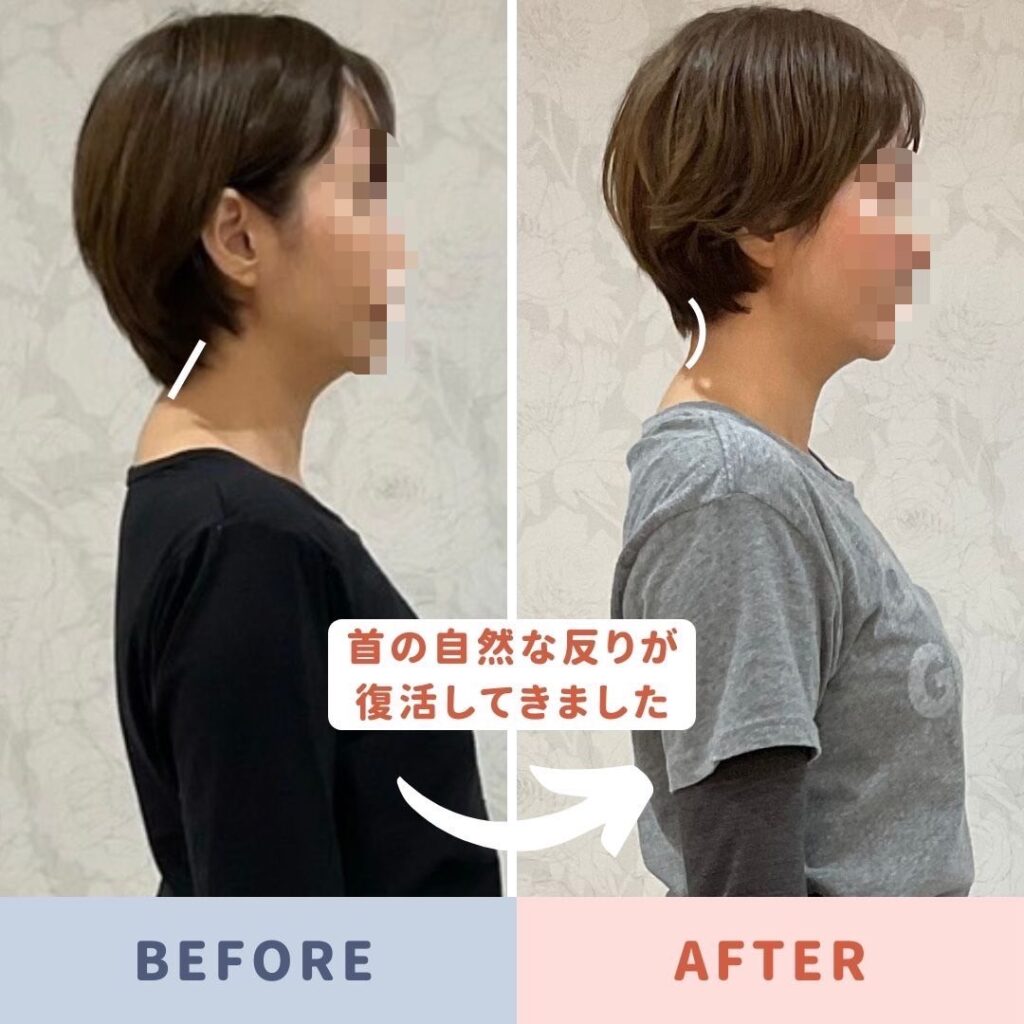 ストレートネックに悩まされていたお客様
