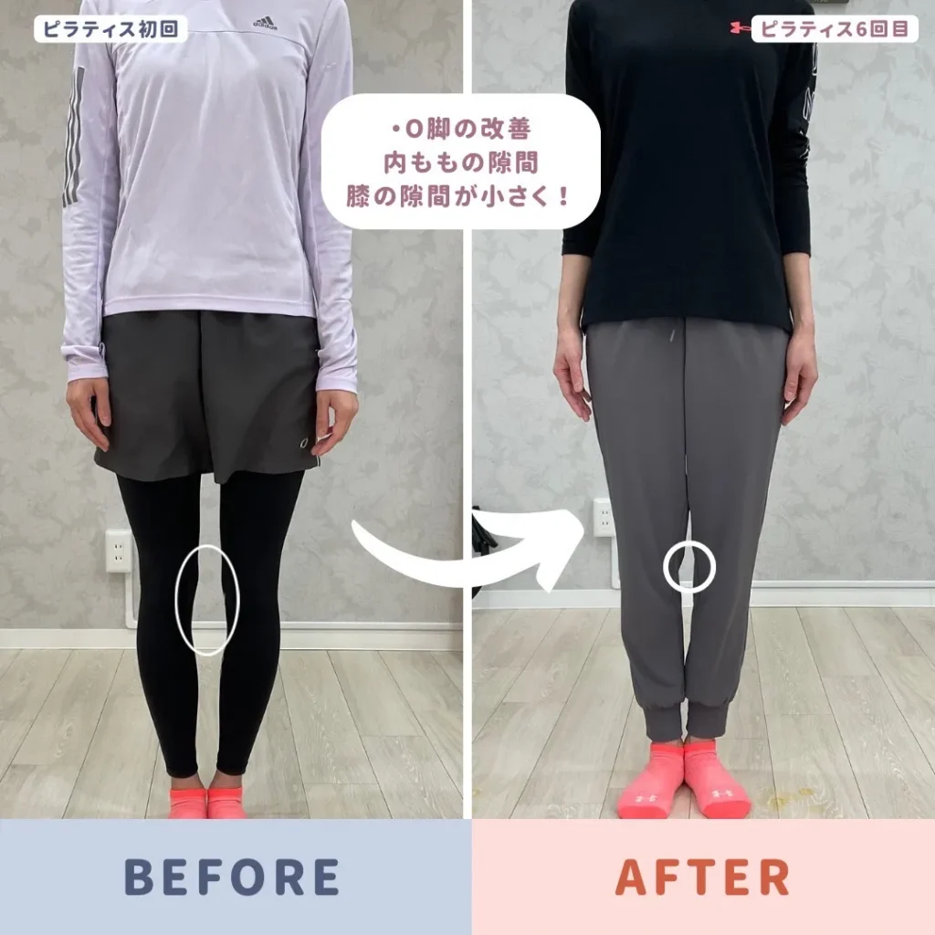O脚に悩まされる女性が改善された