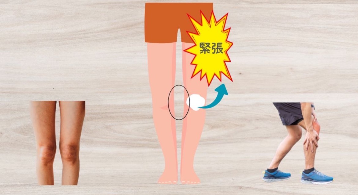 大腿筋膜張筋の過緊張によるデメリット