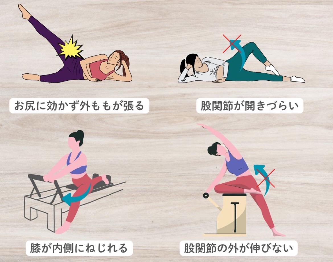 大腿筋膜張筋によるお悩み