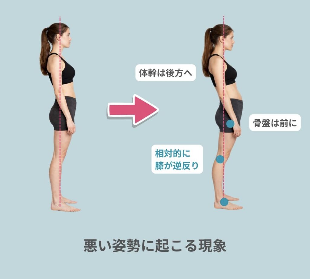 反張膝の原因は?