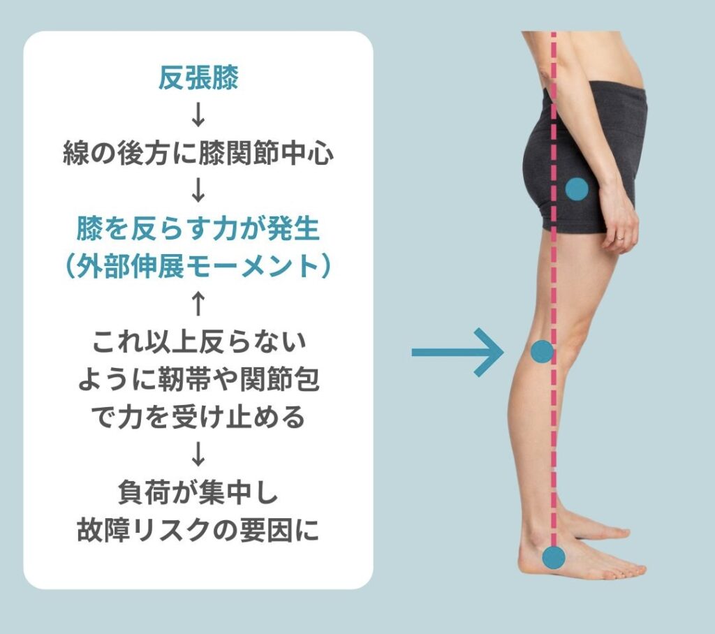 反張膝の見方
