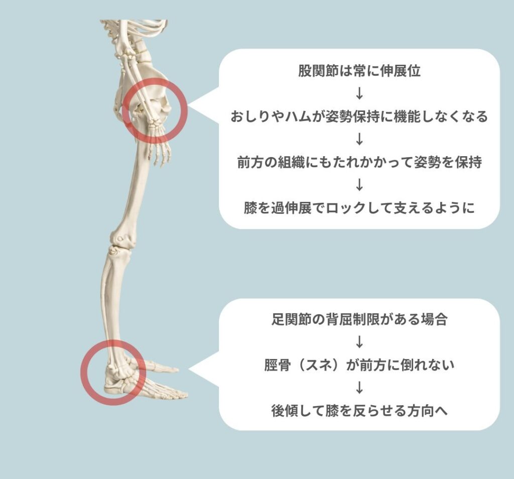 反張膝は膝の問題じゃない!?